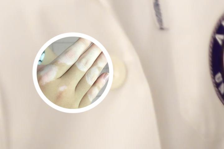 儿童白癜风首选治疗方案