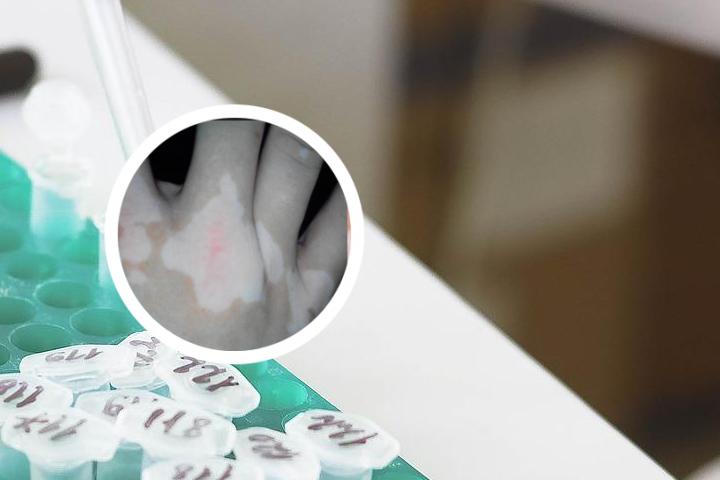 白癜风好了以后还用喝药吗