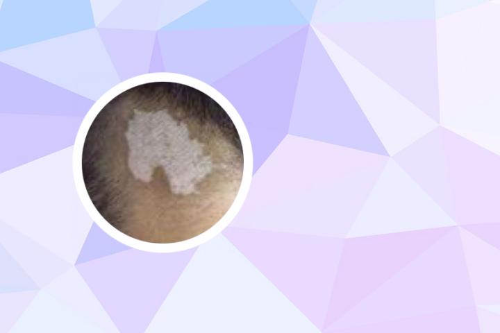白癜风可能出现在头皮吗