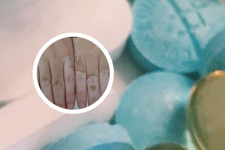 上火对白癜风有什么影响