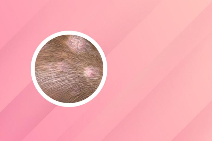 白癜风怎么分辨阶段