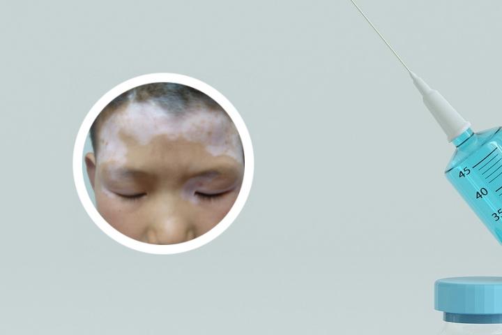 白癜风加重是什么样子