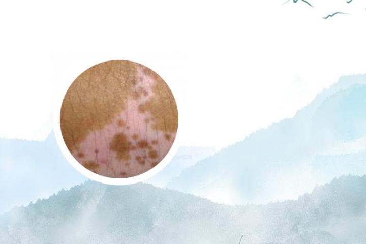 白癜风病人能吃莴笋吗