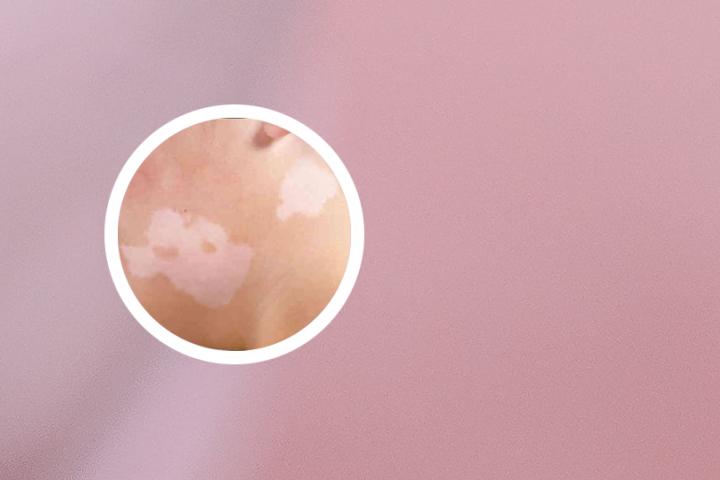 白癜风可以吃鱼胶原蛋白吗