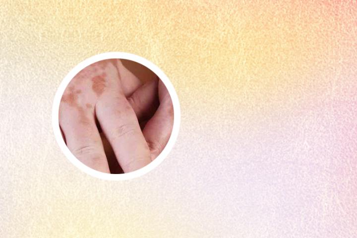 白癜风打针多久能好