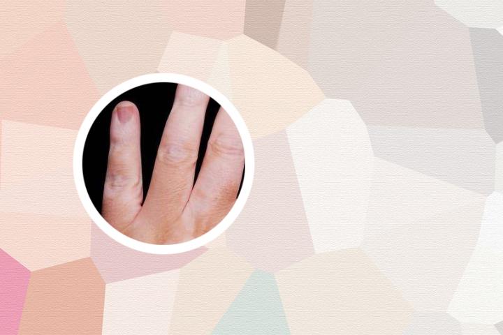 男生会介意女生白癜风吗