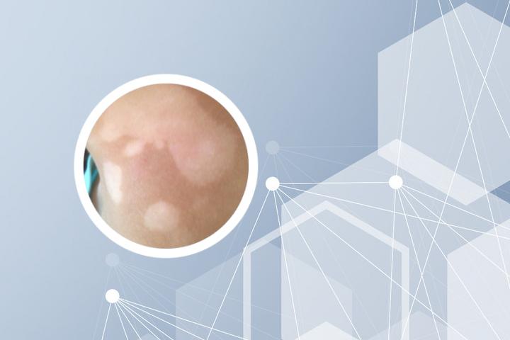 孕妇白癜风可以局部光疗吗