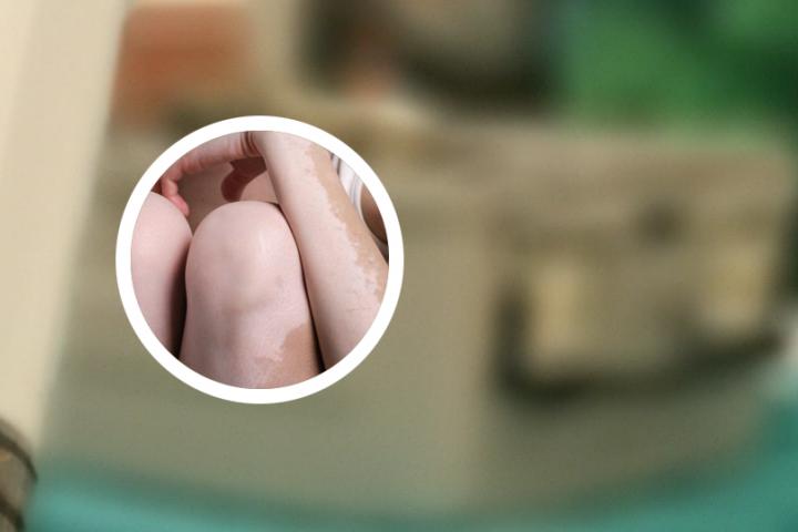 福州中科医院白癜风怎么样
