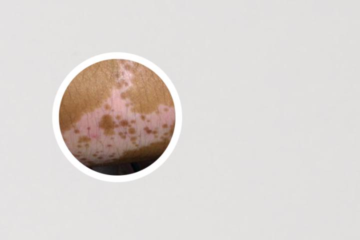 先天性白癜风后遗症