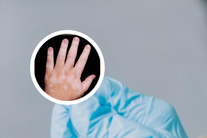 白癜风为什么边治疗边扩散