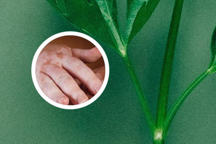 白癜风移植后遗留疤痕么