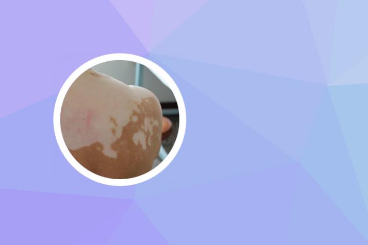 白癜风为何对称性分布 白癜风为何对称性分布