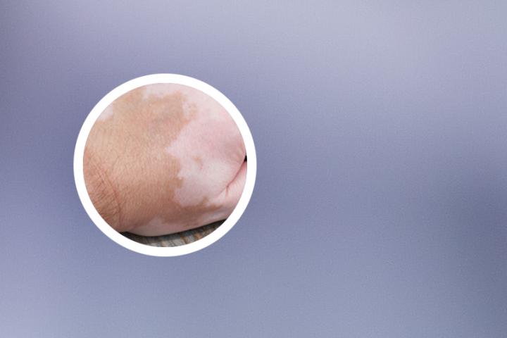 面部白癜风需要全身防晒吗