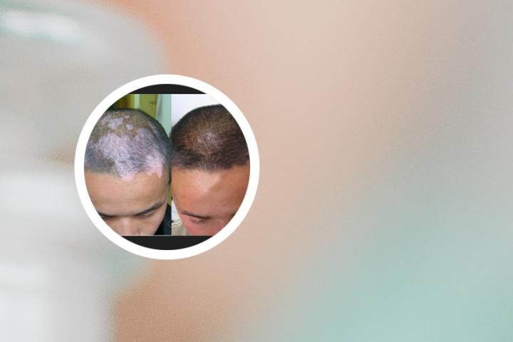 白癜风可以贴纹身贴画吗
