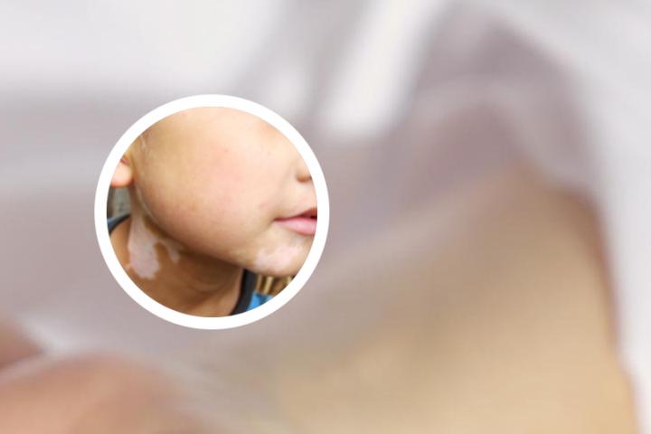 为什么有的白癜风好的慢