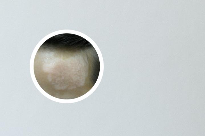 白癜风护理专升本学校学费