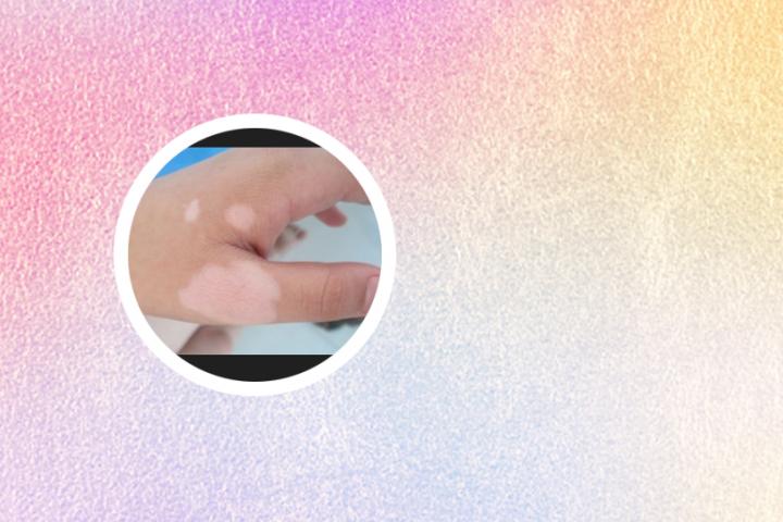 脚上皮肤发白就是白癜风吗