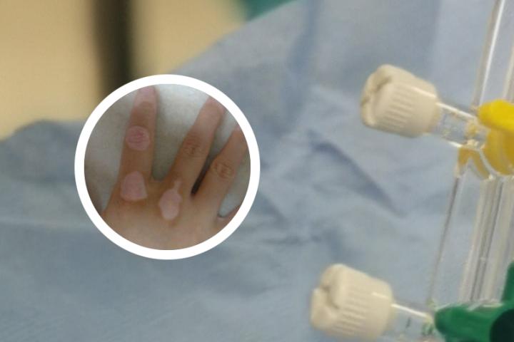 白癜风光疗可以恢复吗