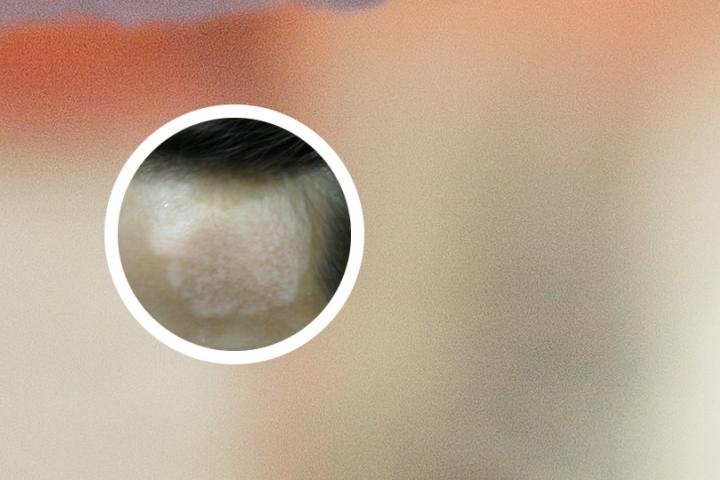 白癜风医院光疗中心