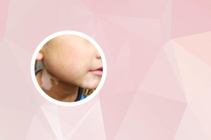 白癜风遗传解释