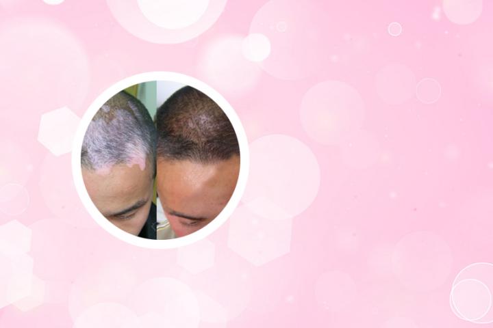 白癜风能吃黑裸麦面包吗
