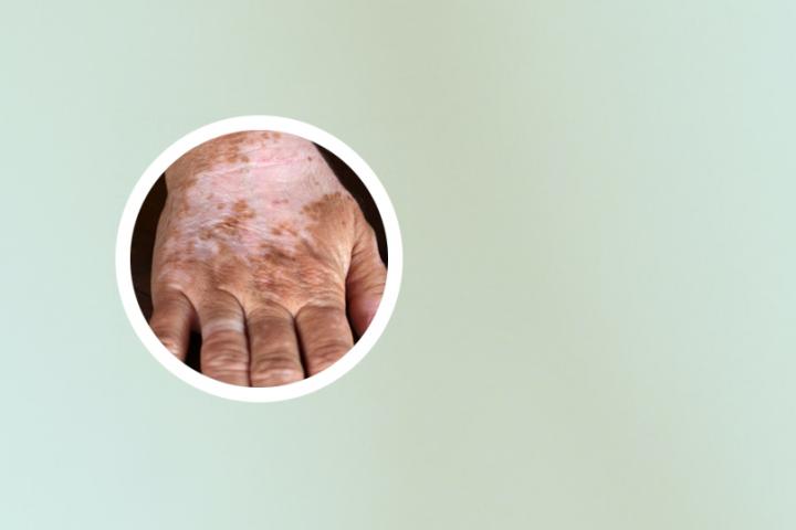 白癜风能用激光打了吗