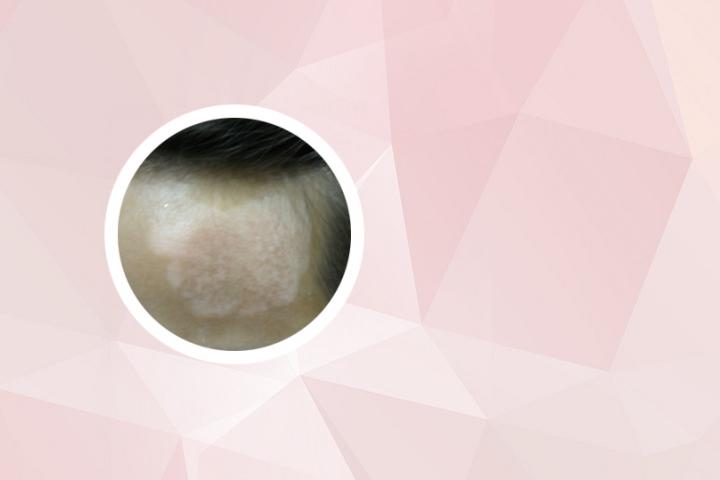 头皮白癜风白发怎样治疗