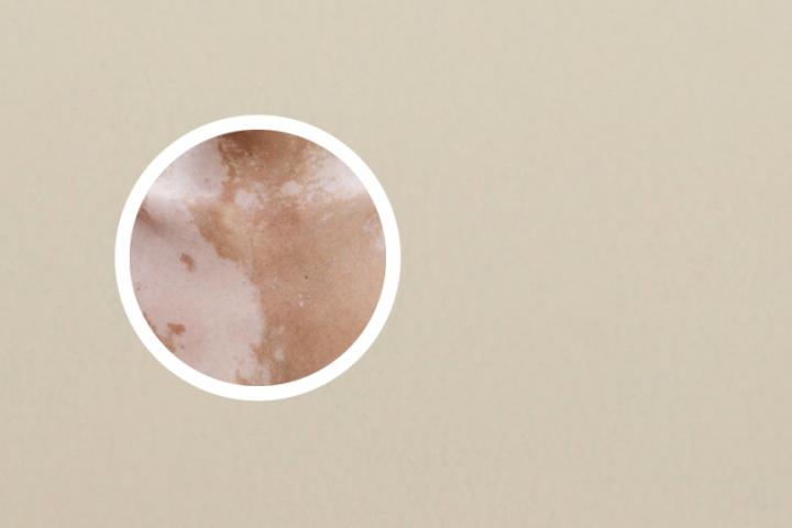 鲜竹沥能治白癜风吗