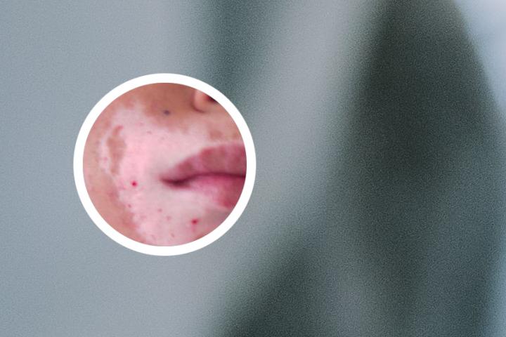 白癜风晚上睡觉的正确方法