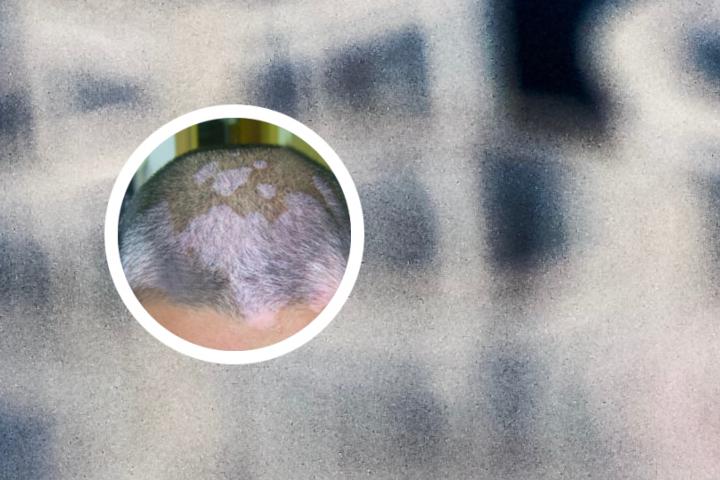 白癜风为何不吃牛肉呢