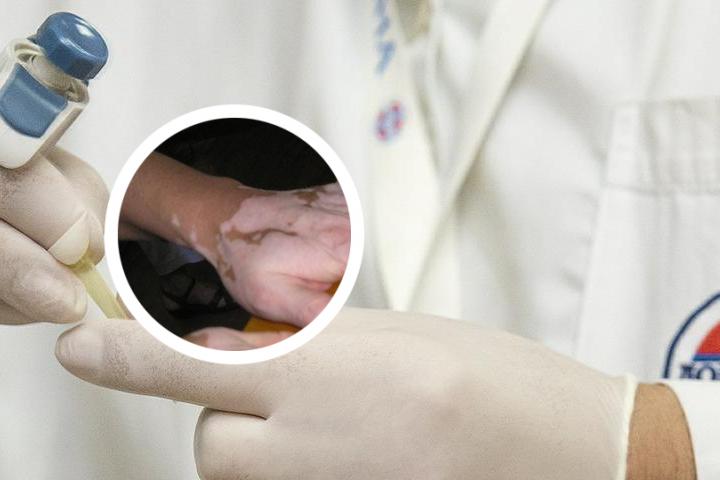 青核桃泡酒可以治白癜风吗
