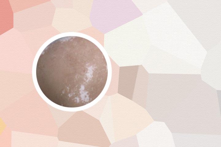 有白癜风病可以吃鱿鱼吗