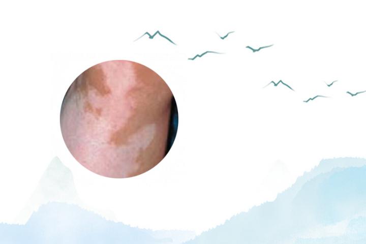 怎样治白癜风病