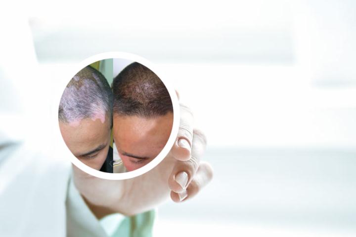 白癜风休息时间
