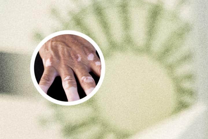 上海白癜风哪家医院能治