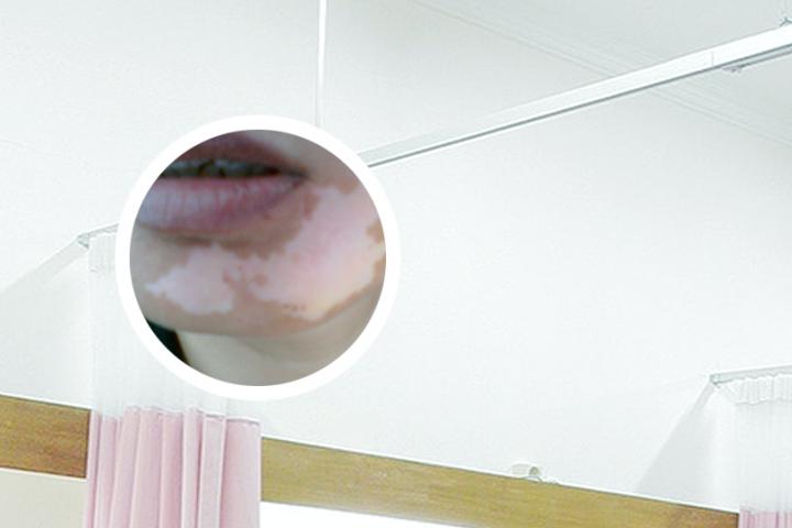 1岁宝宝后背白癜风