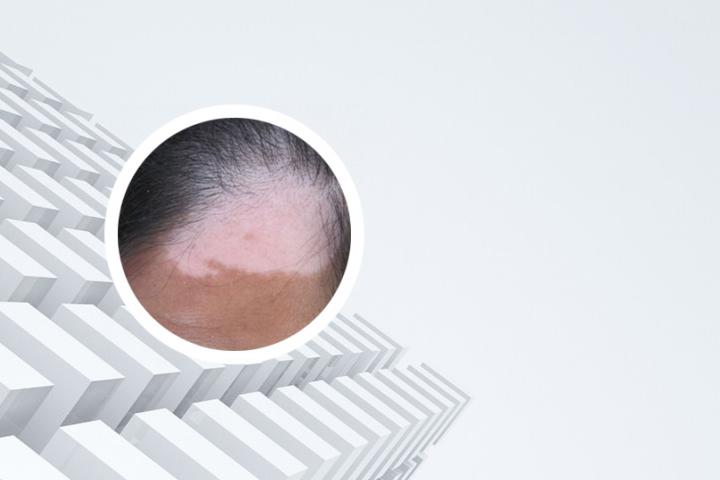 儿童白癜风护理注意事项