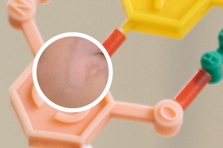 双重白癜风好治吗
