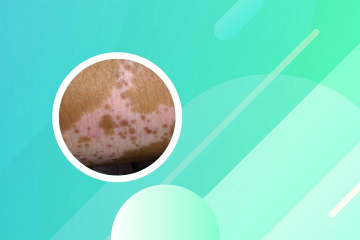 治白癜风打什么针