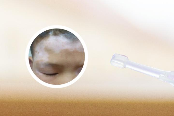 白癜风微循环不好怎么改善