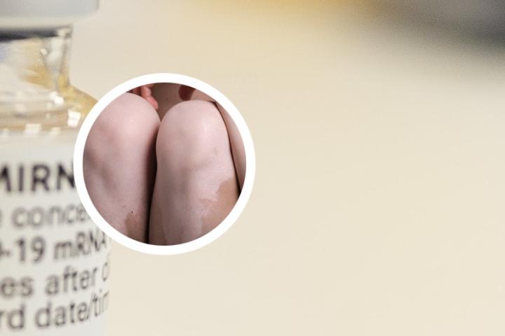 艾叶灰可以治白癜风吗