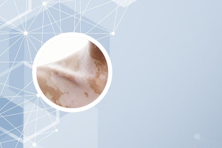 怎么让白癜风治愈
