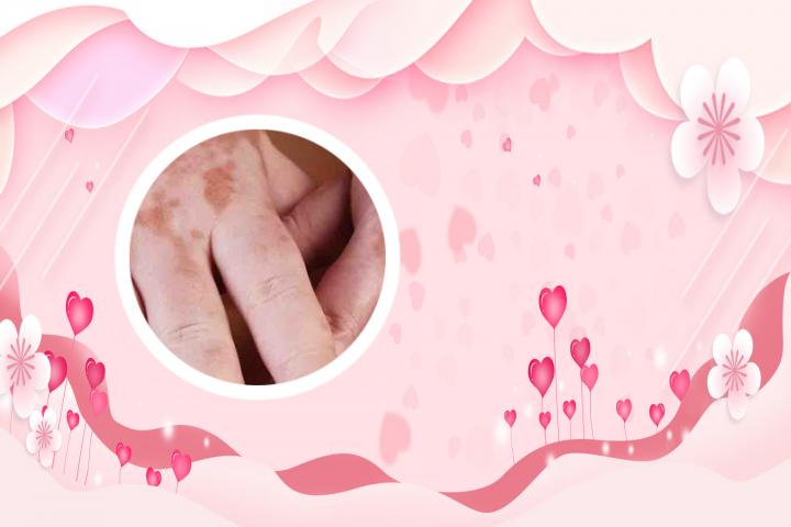 白癜风维生素b能经常吃吗