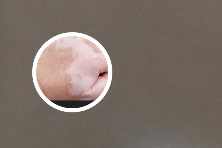 小孩子白癜风治疗费用多少