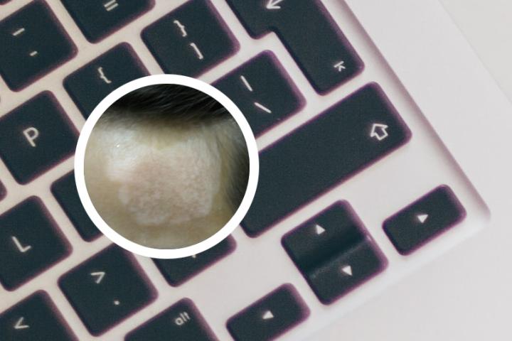 白癜风患者能给宝宝母乳吗