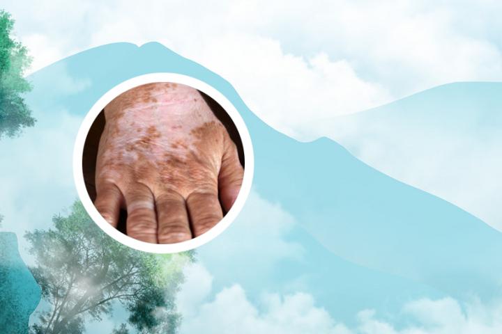 白癜风患者可以剧烈运动吗