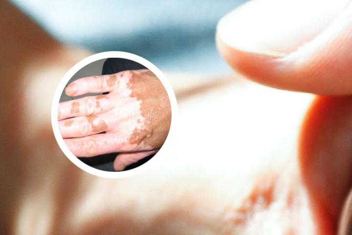 白癜风为啥要少吃甜的