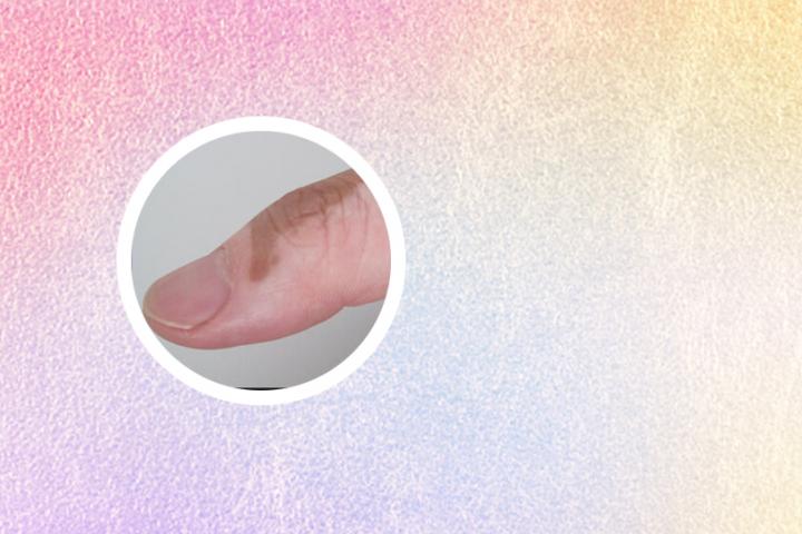 白癜风网红大赛 白癜风网友分享