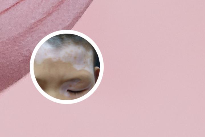白癜风光子可以脱毛吗