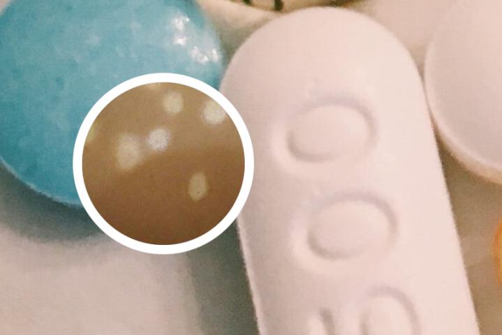 小孩缺铁会引起白癜风吗